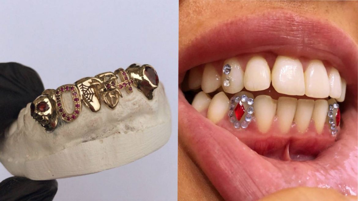 Different types of dental grillz you can get