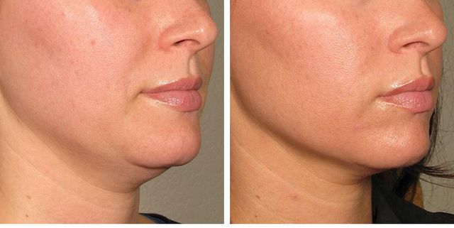 How To Know Which Non-Surgical Skin Tightening Procedure Is Right For You